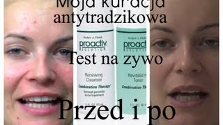 Moja najskuteczniejsza kuracja antytradzikowa/ test na zywo przed i po