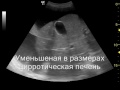 Нажмите для просмотра : Цирроз печени. Асцит или как