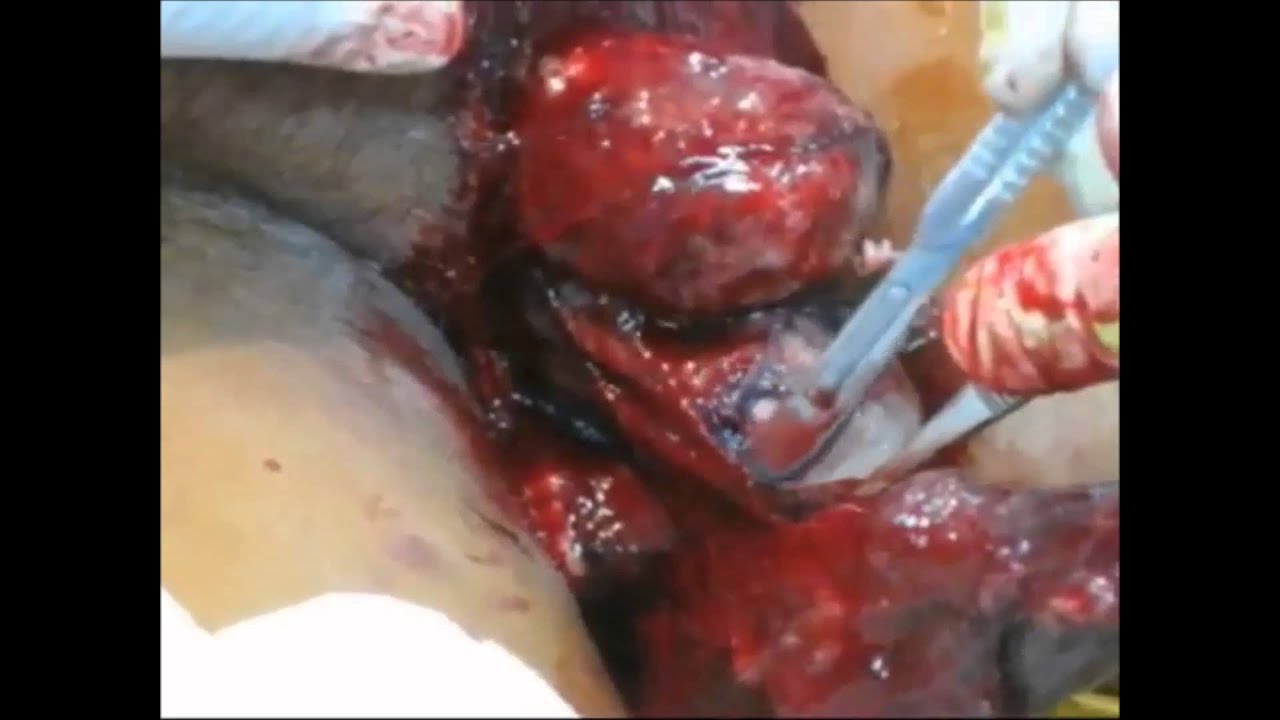 Fournier's Gangrene - YouTube