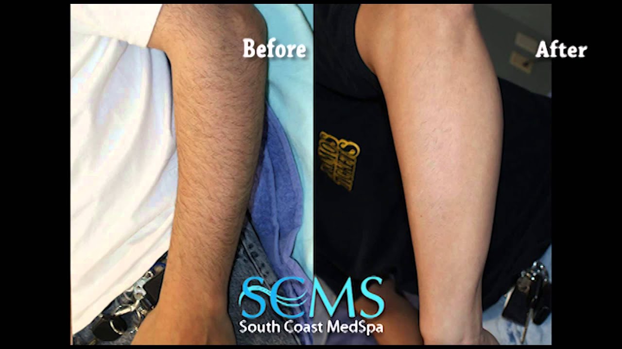 Before and After Male Laser Hair Removal Orange CountyArms YouTube