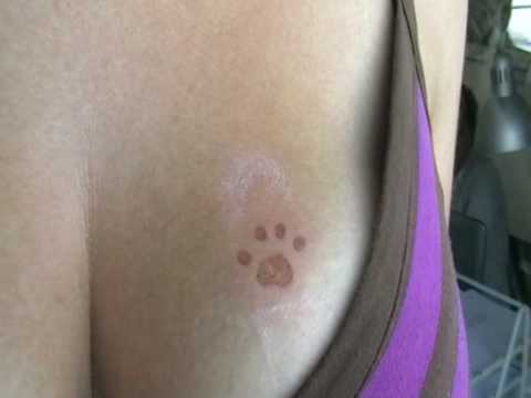 allergic reaction to black henna tattoo before treatment allergic reaction to black henna tattoo before treatment