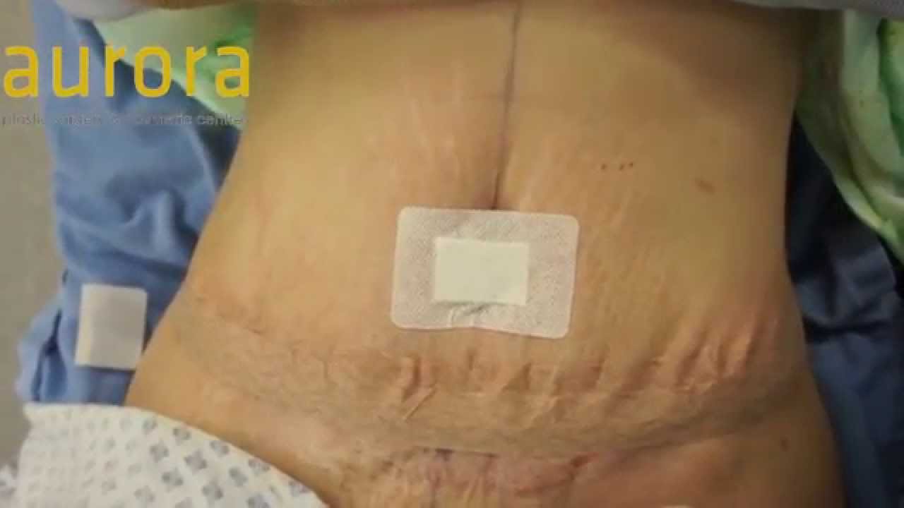 youtube tummy tuck gone wrong