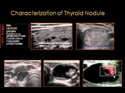 thyroid ultrasound - YouTube