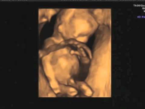 12 Week 4D Ultrasound-Can you Tell the Gender? - YouTube