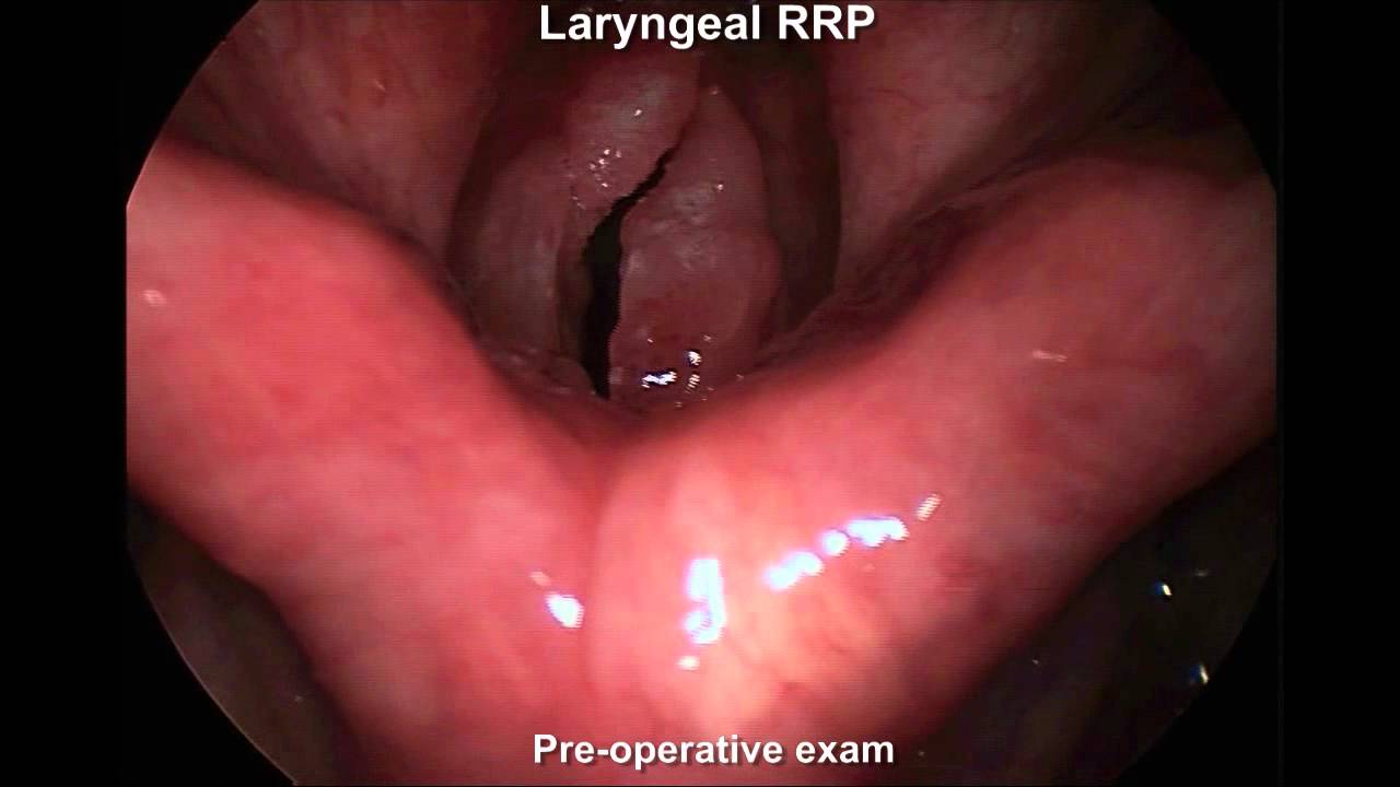 Laryngeal papilloma (opera singer) - MGH Voice Center (Ex 2) - YouTube