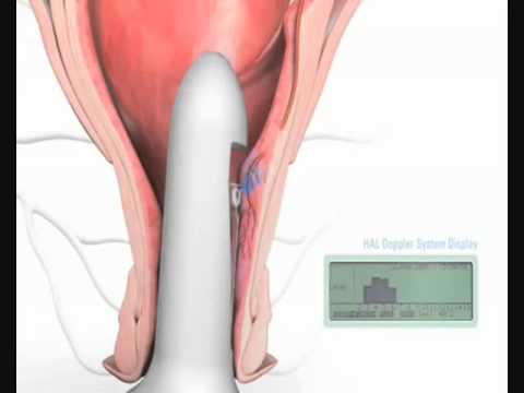 external hemorrhoids