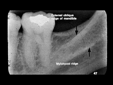 Dental Radiographic Anatomy - YouTube