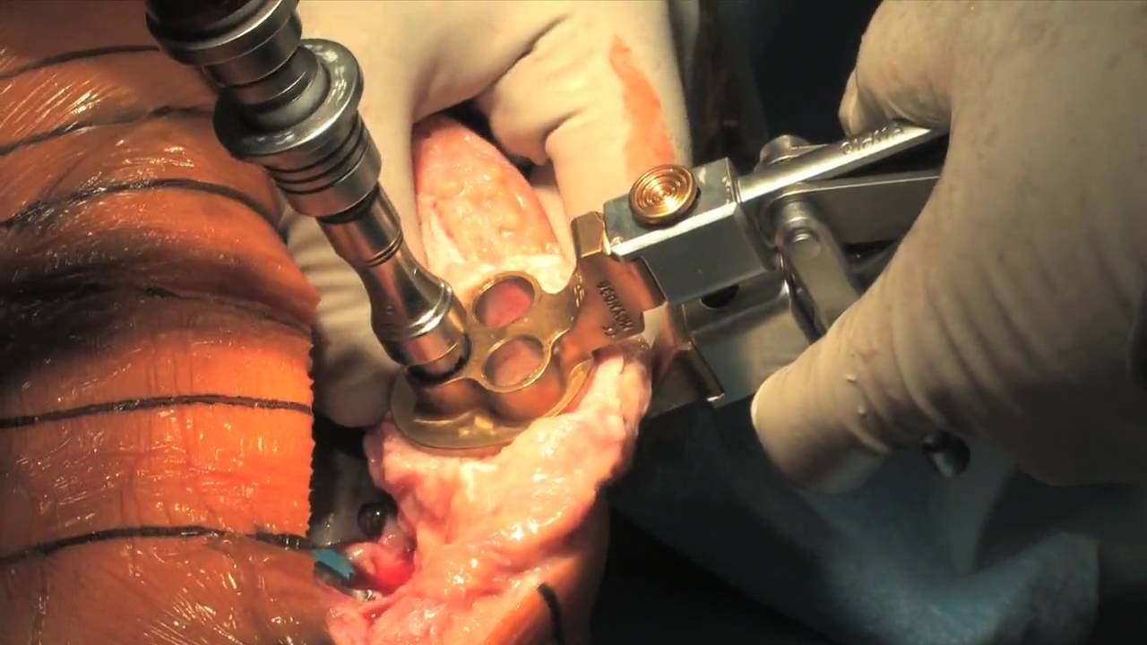 Total Knee Replacement Part 2 The Surgical Procedure