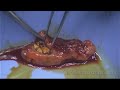 Gallbladder removal surgery