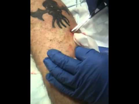 Draining infected tattoo