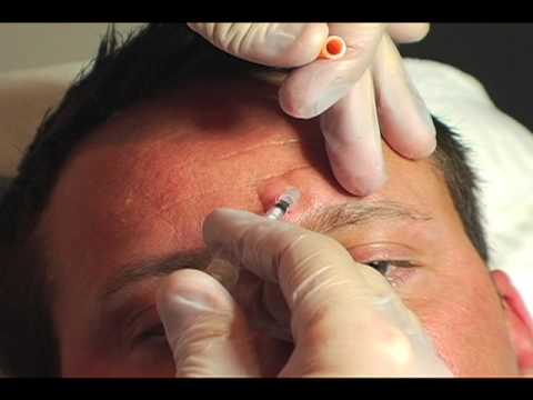 Watch EYE WRINKLES: www.youtube.com Dramatic Video of Botox Before and After 