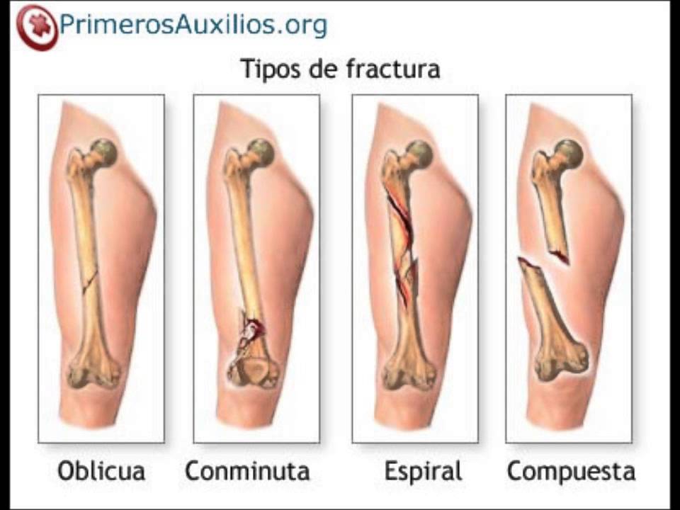 DE LESIONES EN EL BASQUET de lesiones en el basquet: