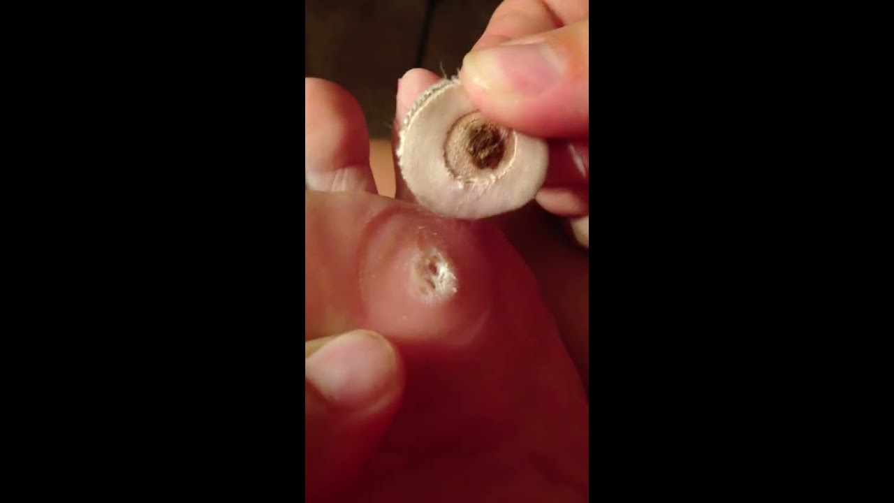 Nasty and gross plantar wart on bottom of foot! - YouTube