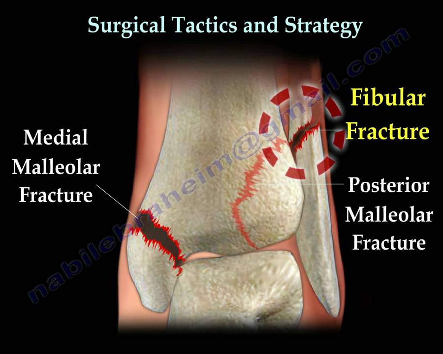Ankle fracture / Fractures and its repair- Everything You Need To Know