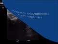 Нажмите для просмотра : Остеосинтез надколенника при его переломе