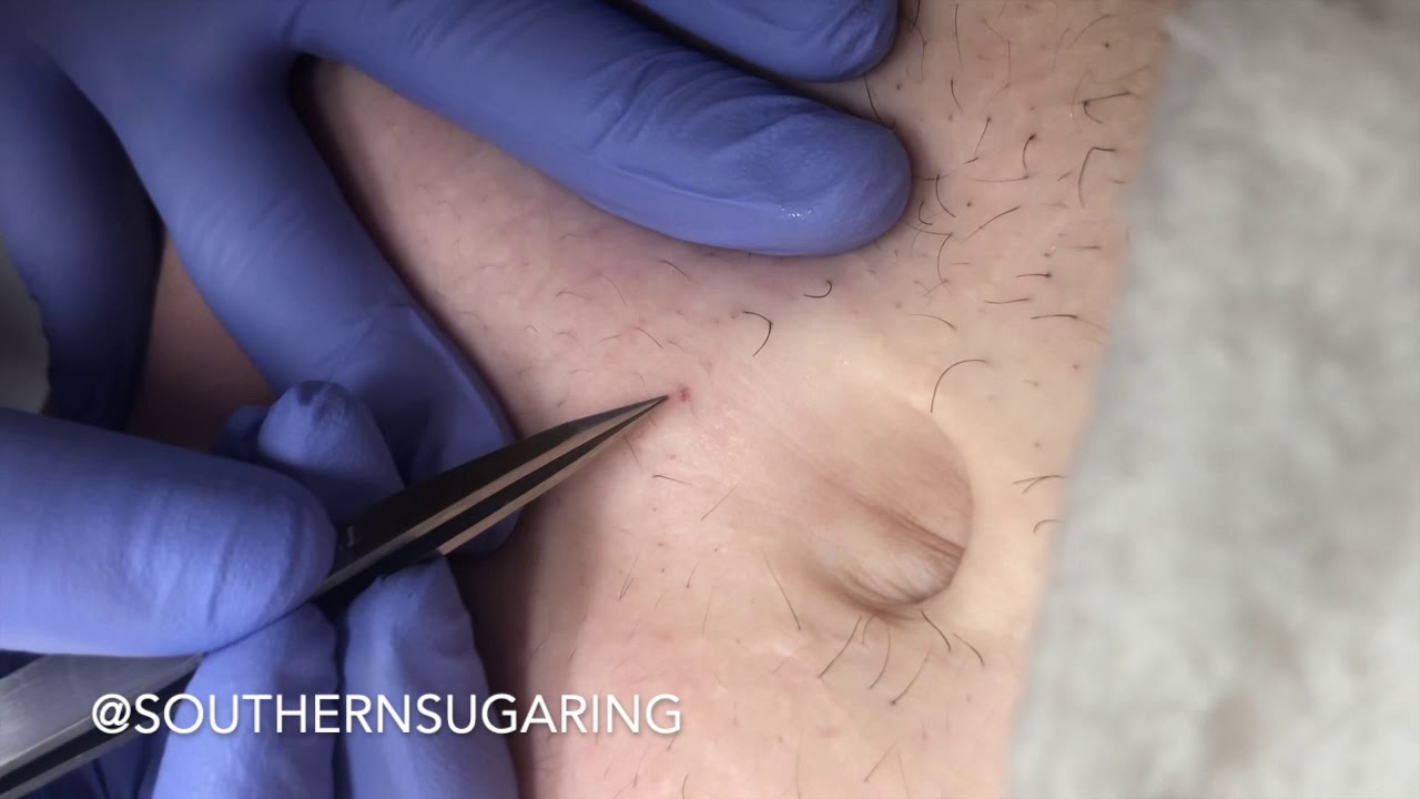 How To Remove Hair From Belly Button
