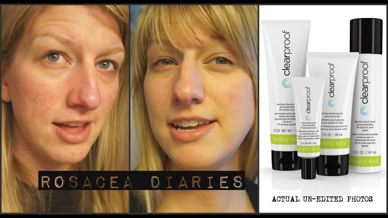 Mary Kay Clear Proof Review Rosacea Diaries YouTube
