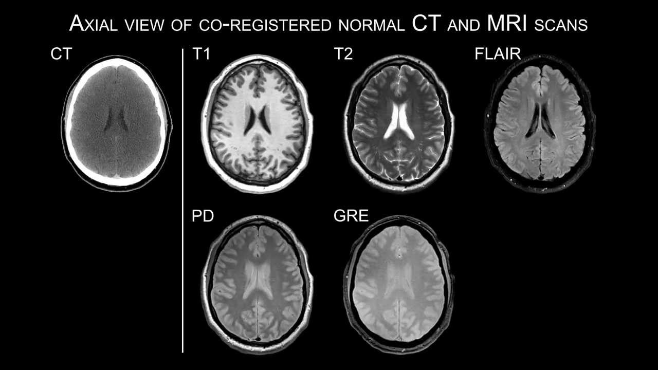 Axial view of co-registered normal CT and MRI scans - YouTube