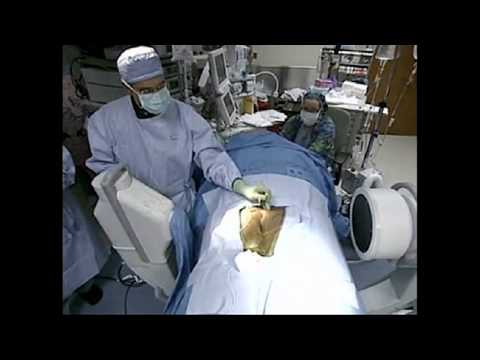 bladder stimulator implant