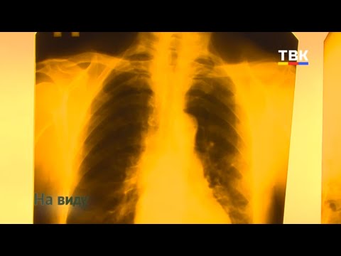 В Искитиме вспышка пневмонии