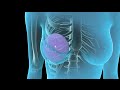3D Medical Animation: Breast Reconstruction after a Mastectomy