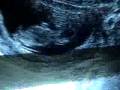 Ecografía Embarazo 11semanas- Movimientos Fetales, Gestation