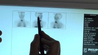 Parathyroid Tumors And Sestamibi Scans: How to Read The Scan