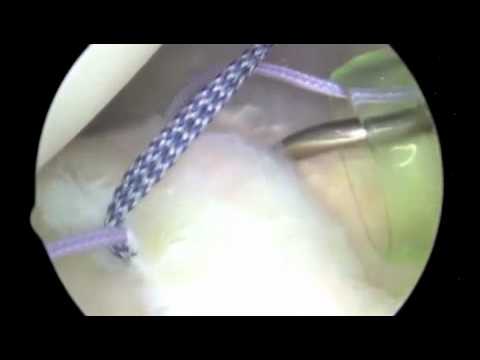 Posterior Instability - YouTube