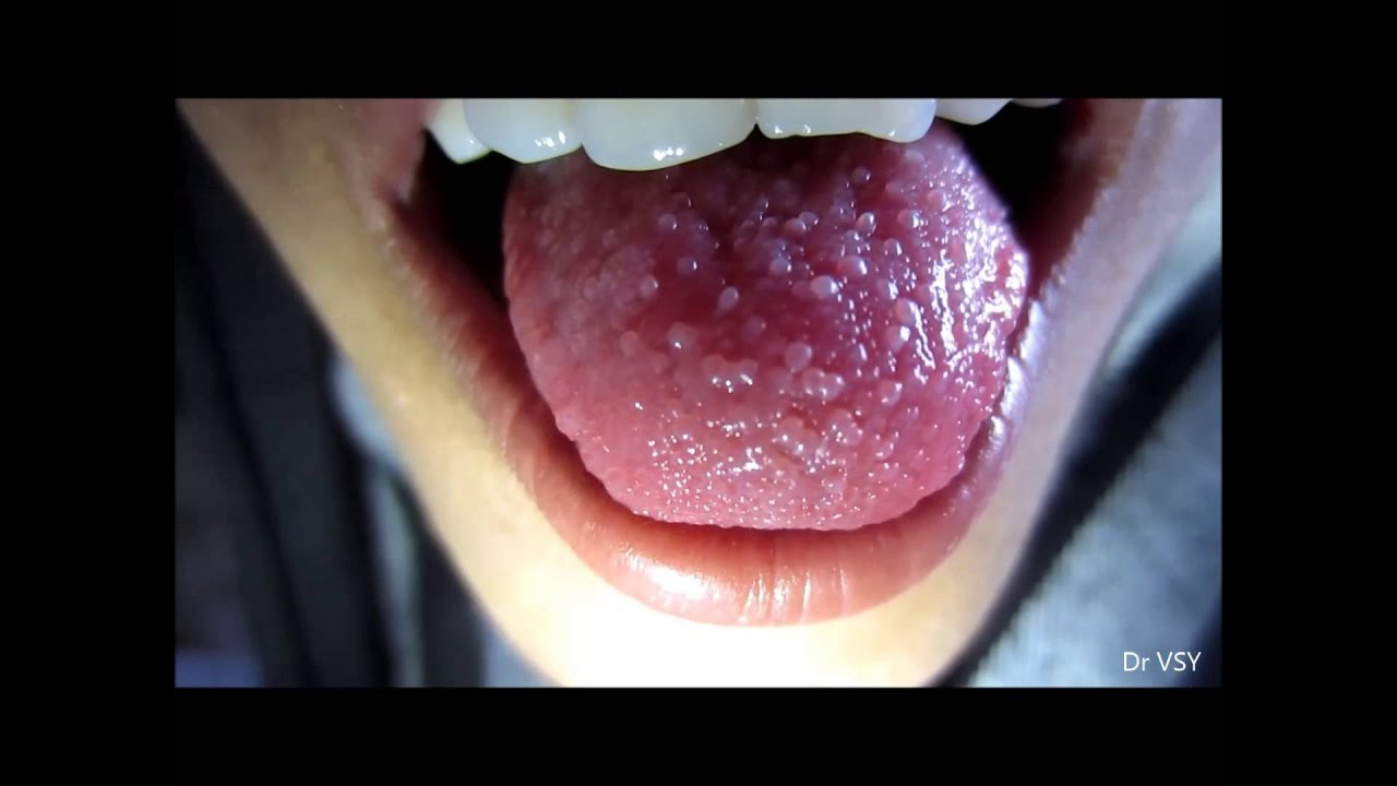 Papillitis Tongue - YouTube