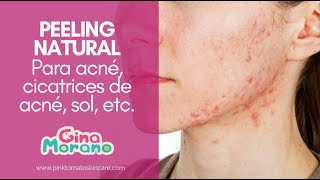 Quitar manchas y acné con peeling natural