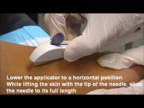 Implanon NXT insertion june 2011.wmv - YouTube Implanon NXT insertion june 2011.wmv - YouTube