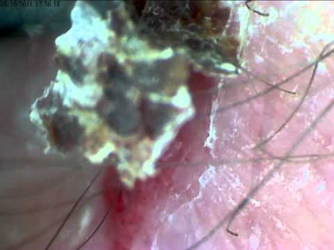 Under The Microscope - The One Inch Scab (Sliced And Diced) - YouTube