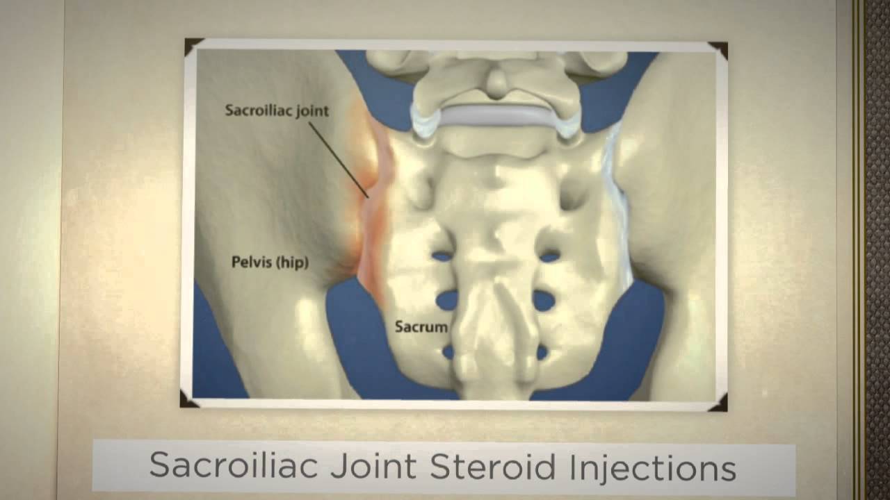 Dr. Kornick Riverside Spine Jacksonville (904) 3891010 Sacroiliac