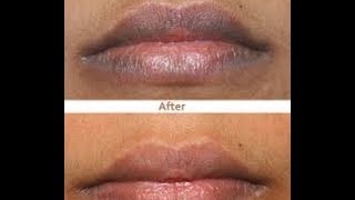 Como Aclarar Los Labios OSCUROS / How to Lighten your Lips