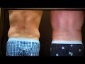 Video: Male Liposuction of flanks
