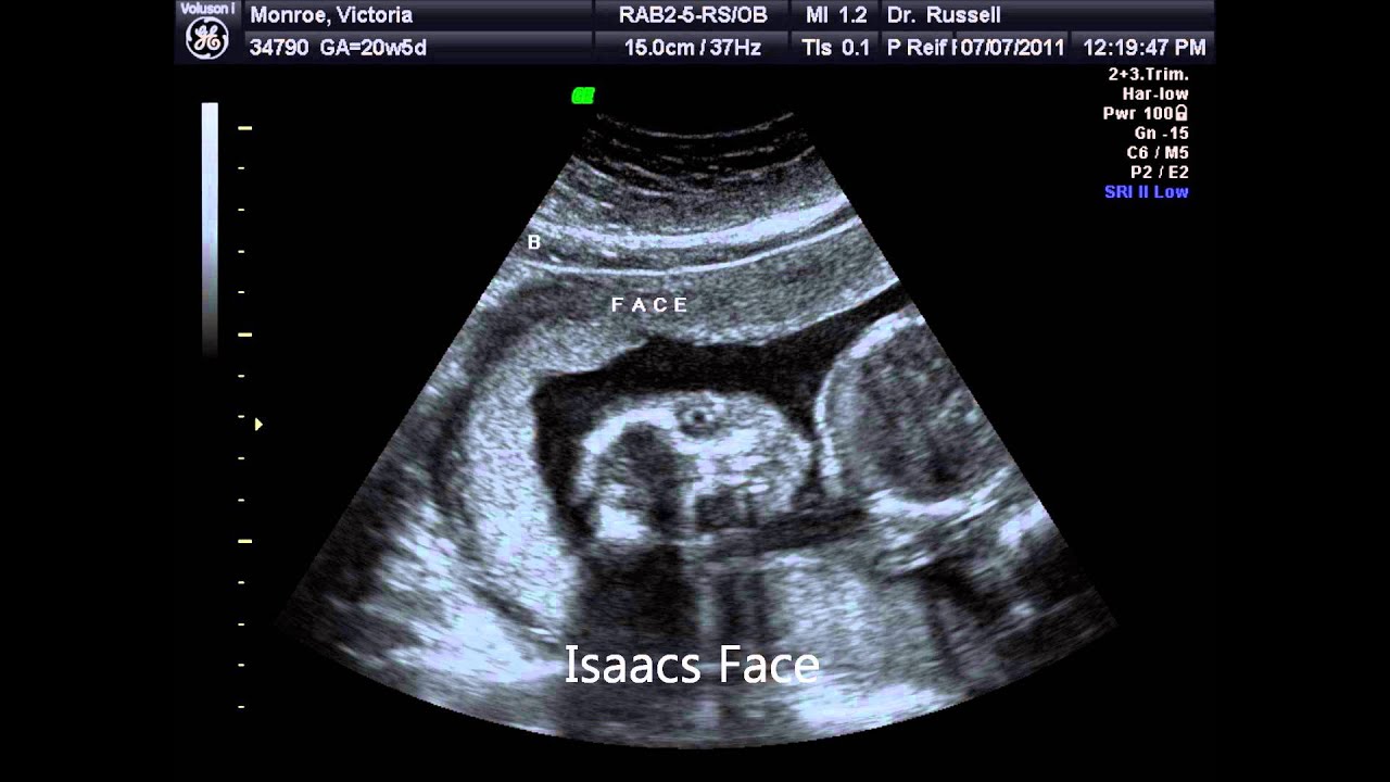 20 weeks and 5 days twin 3D ultrasound - YouTube