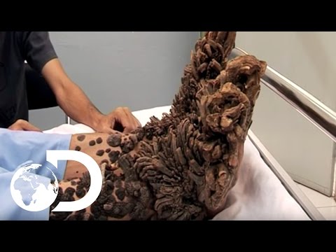 My Shocking Story: Treeman the Cure - Hospital Life - YouTube