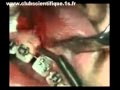 freinectomie labiale ( superieur)