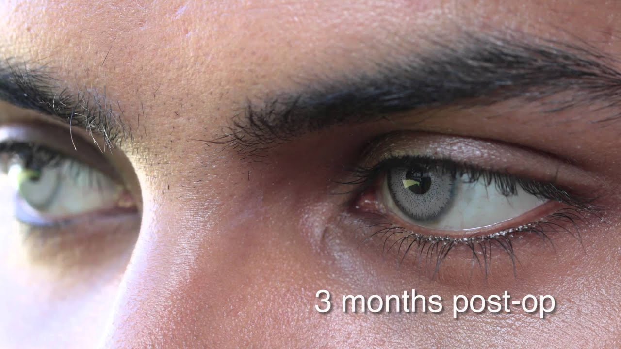 Eye color change surgery 3 months post op / brightocular