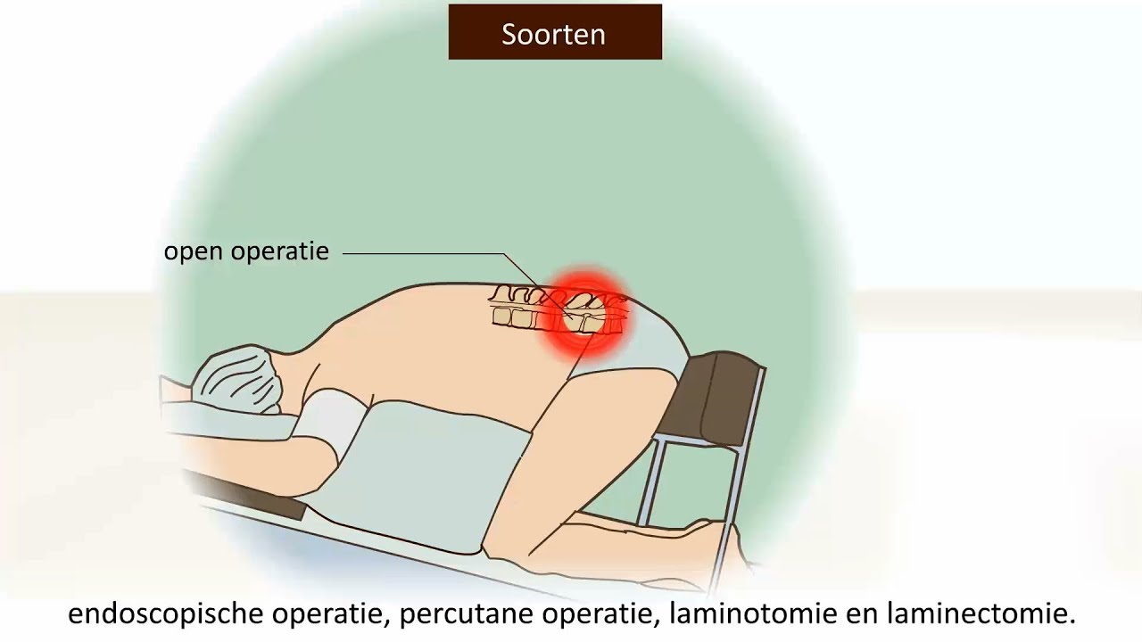 oefeningen lage rug hernia