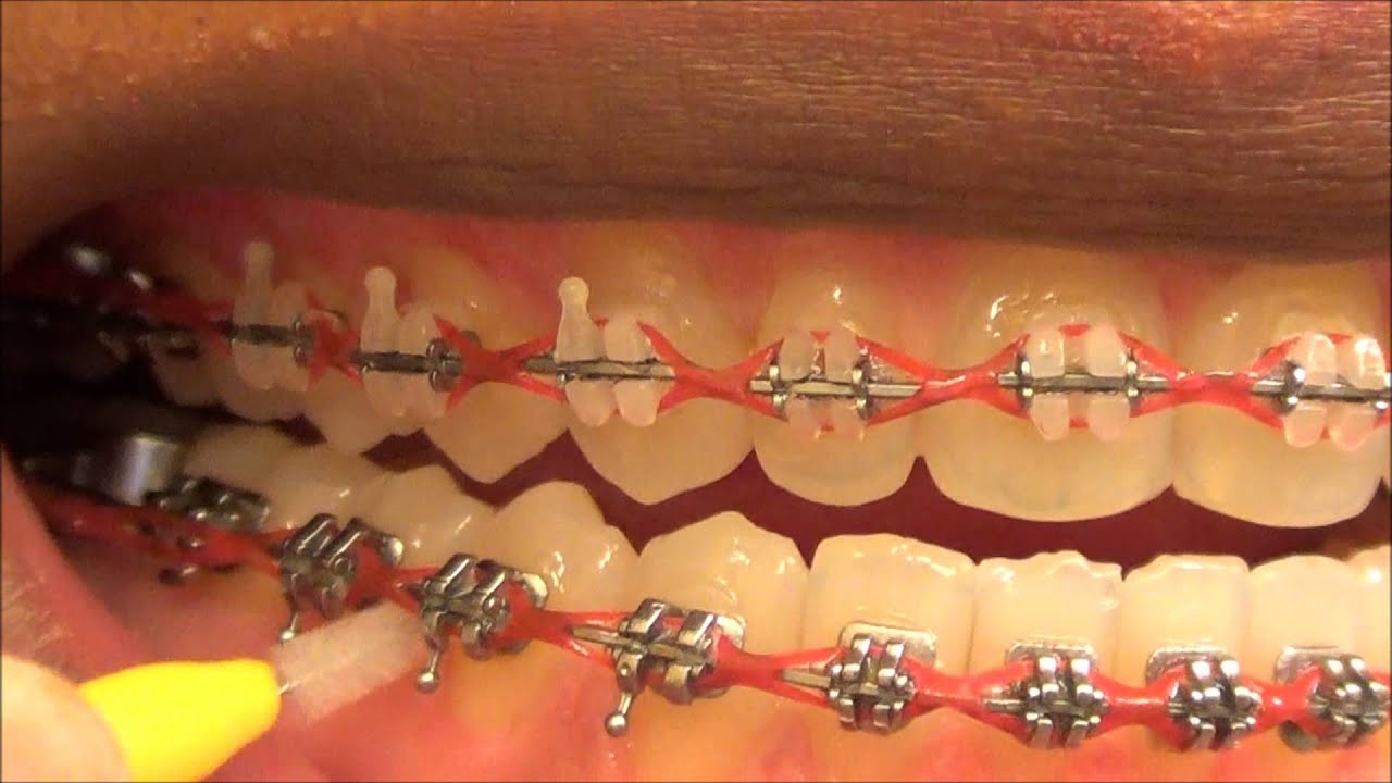 {111} HOW TO USE MY INTERDENTAL TOOTHPICKS WITH BRACES ON YouTube