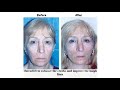 Video: Plastic Surgery - mid face thread lift