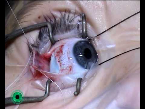 Strabismus surgery , Muscle testing p12/56 - YouTube