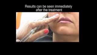 Fillers Treatment