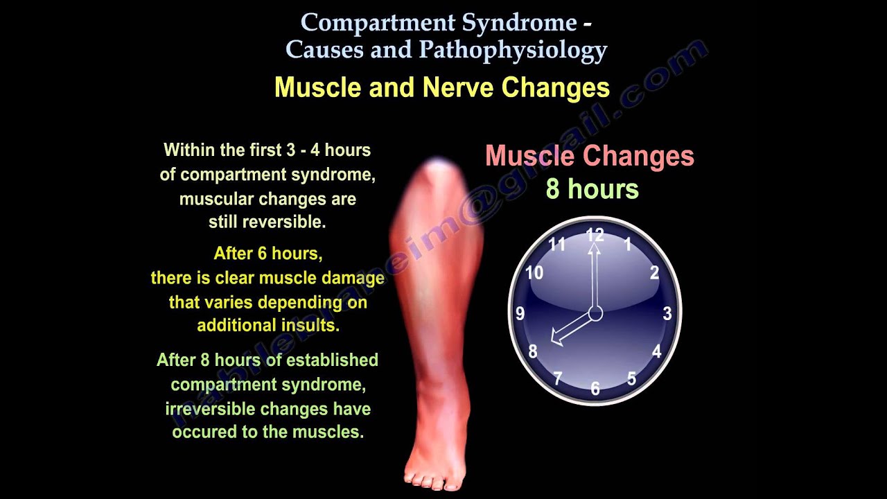 Compartment Syndrome Causes & Pathophysiology - Everything You Need To