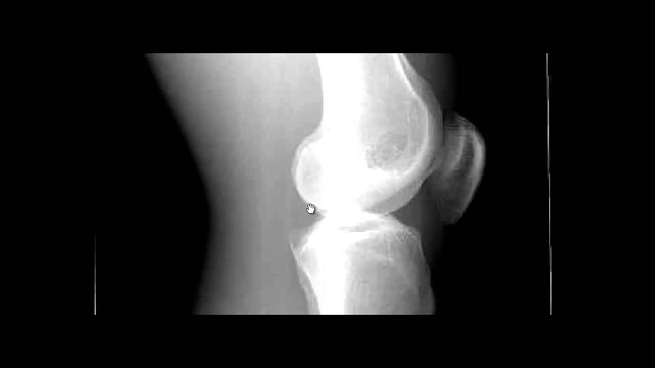 Lateral Knee Xray and Rotation YouTube