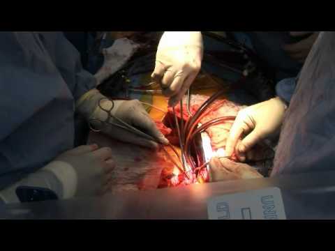 Open Heart Surgery Performed at Christian Hospital in St ...
