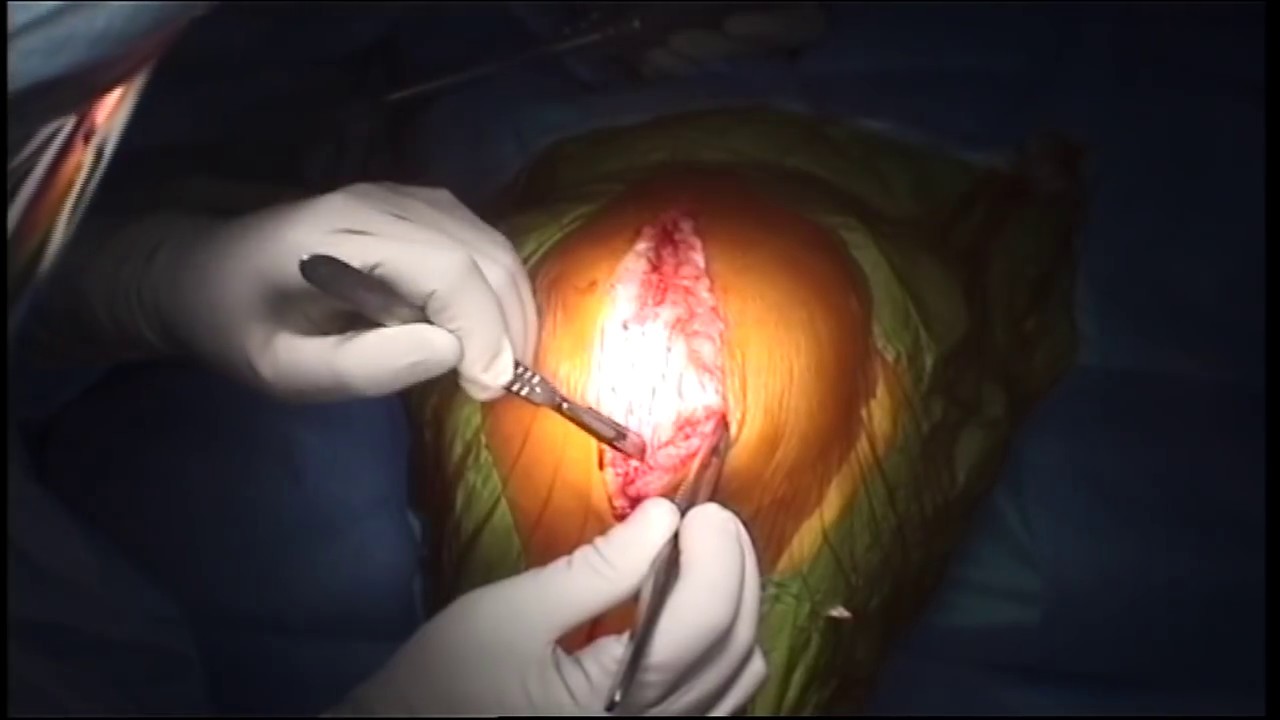 Revision Total Knee Replacement YouTube