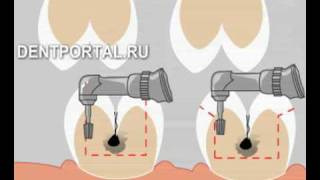 Зубные вкладки - лечение зубов, стоматология