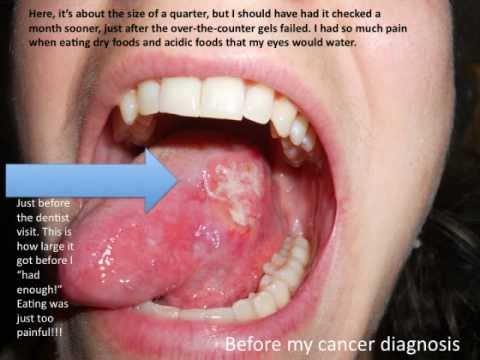 Michael Douglas Had Tongue Cancer -  Not Throat Cancer
